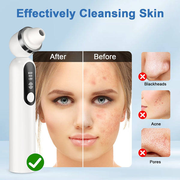 NEXPURE Blackhead Remover Vacuum, Blackhead Extractor with Camera, Pore Cleanser for Men and Women, Skin Care Tool with 5 Probes